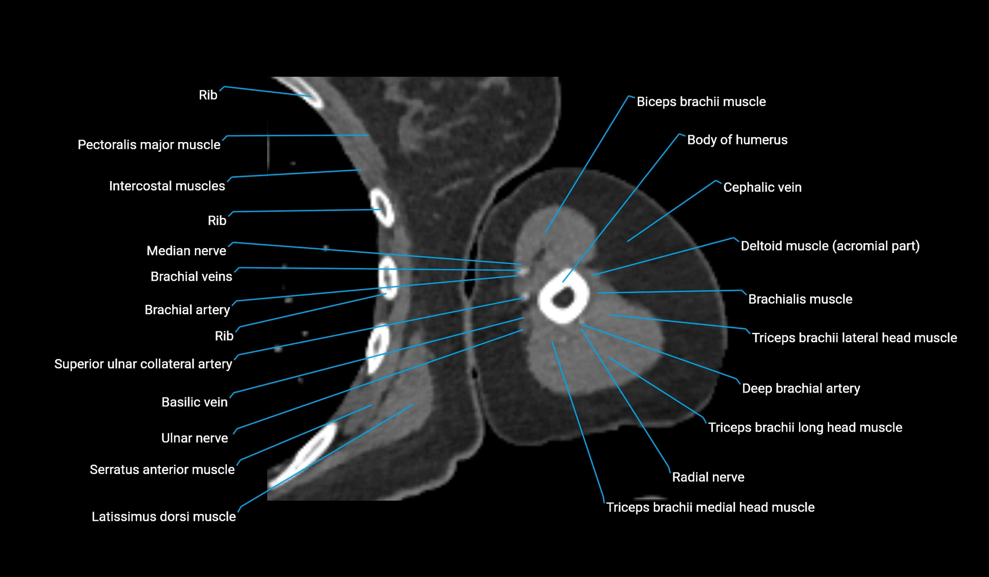 CT upper arm axial  cross sectional anatomy labelled radiology image -00228.webp
